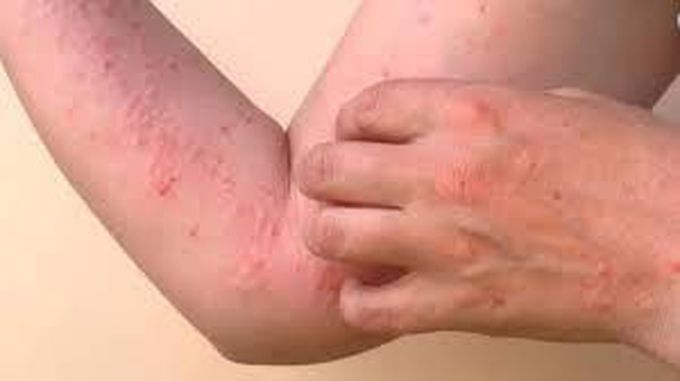 What causes chickengunya?