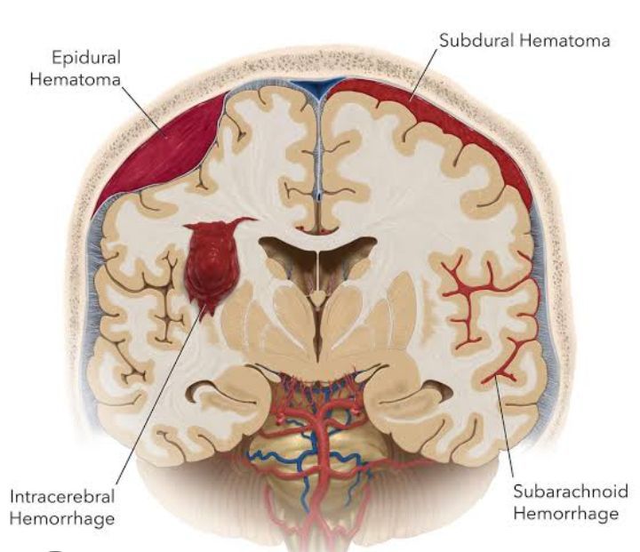 Subarachnoid hemorrhage - MEDizzy