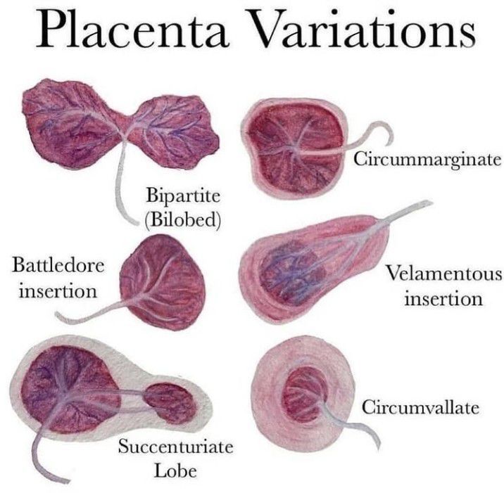 Placenta Variations - MEDizzy