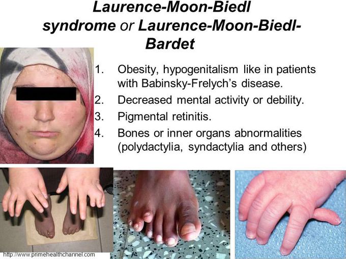 Sx Lawrence Moon Biedl