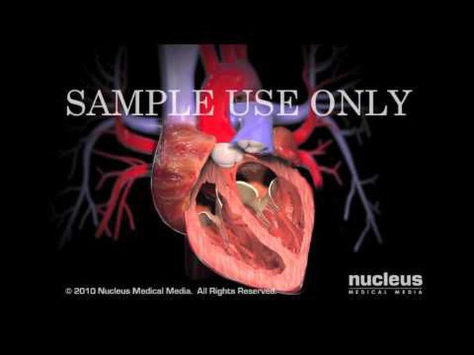 Aortic Valve Replacement- Animated