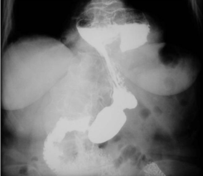 Hourglass Appearance in Esophageal Hiatal Hernia