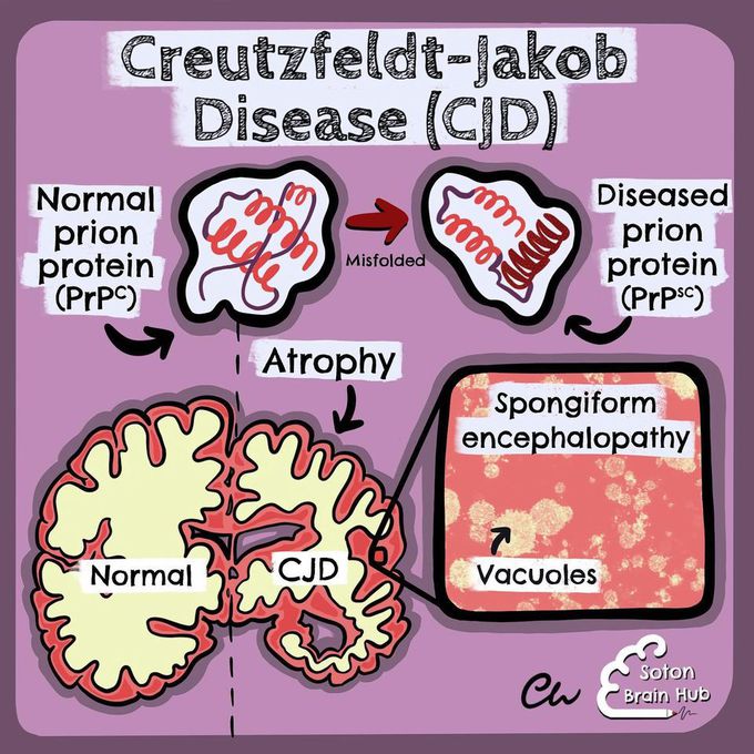 Creutzfeldt Jakob MEDizzy