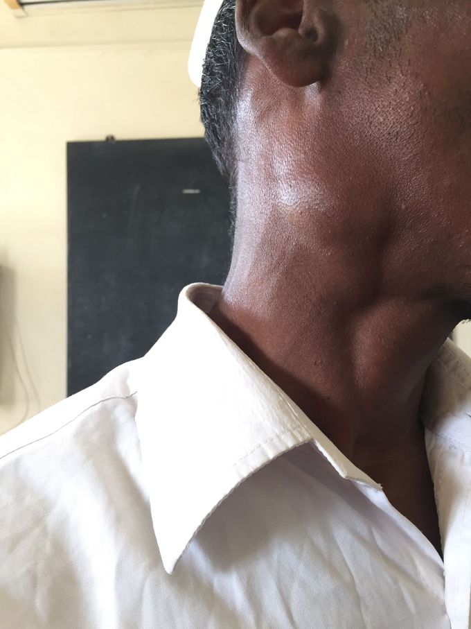 Cervical Lymphadenopathy