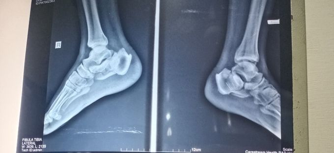 Heel fracture