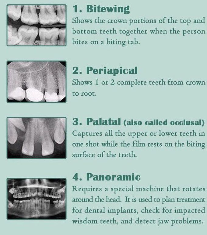 Types of dental X-rays