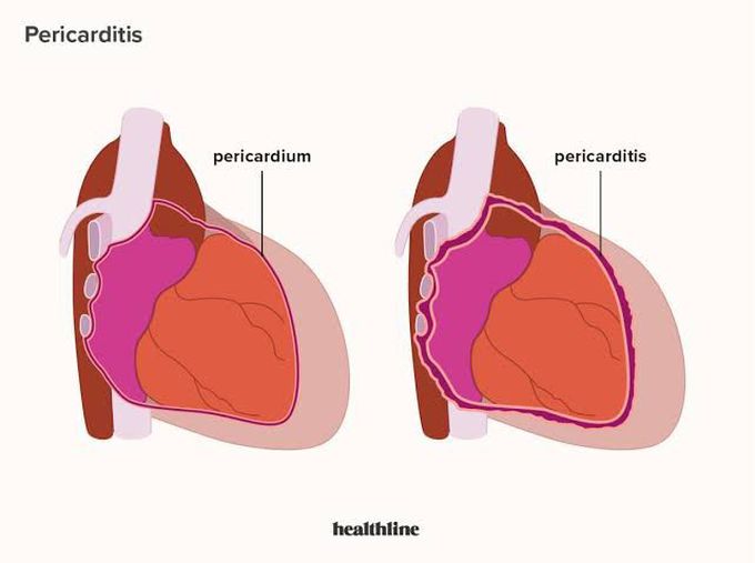 Pericarditis treatment