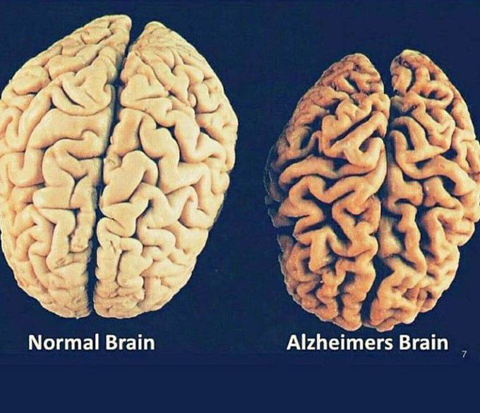 Alzheimer's patient brain