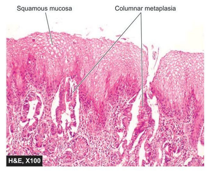 Barrett’s oesophagus.