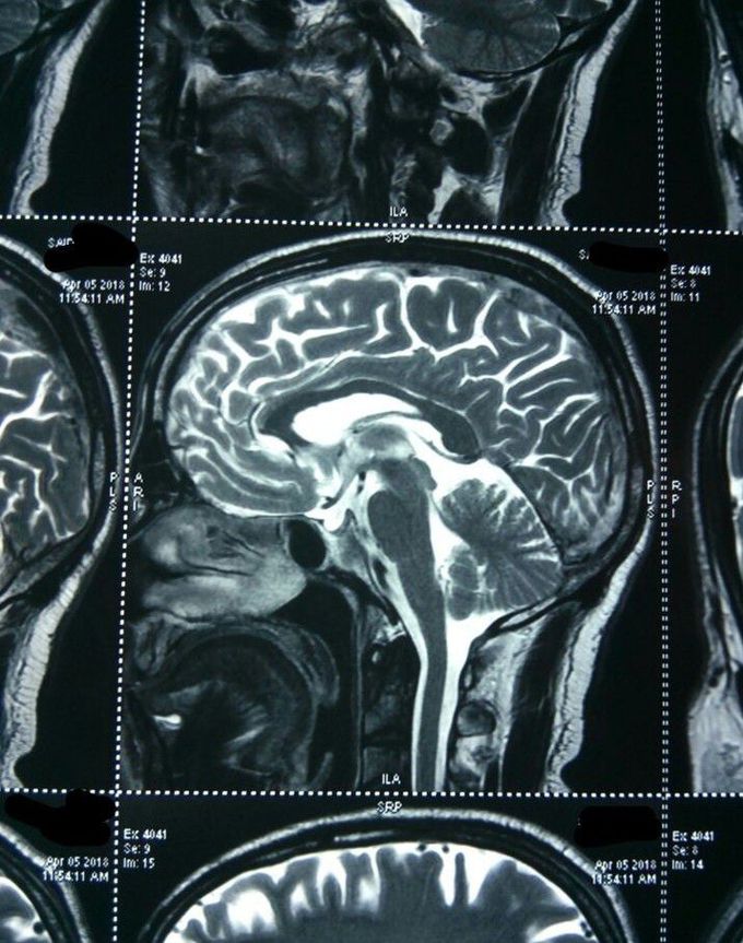 Headache for evaluation