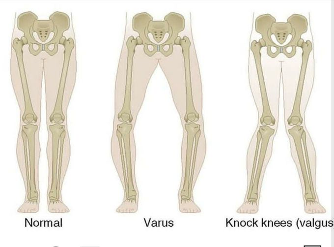 Knock knees