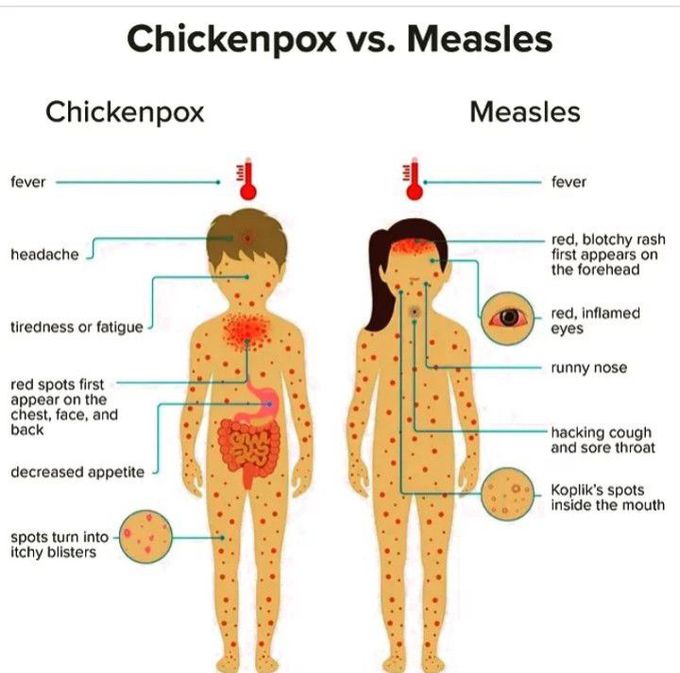 Chickenpox vs measles