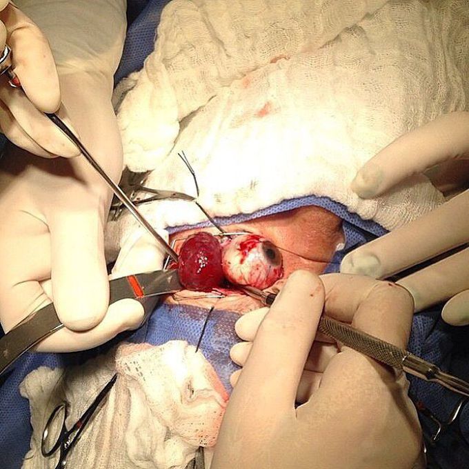Orbital cavernous hemangioma surgical removal