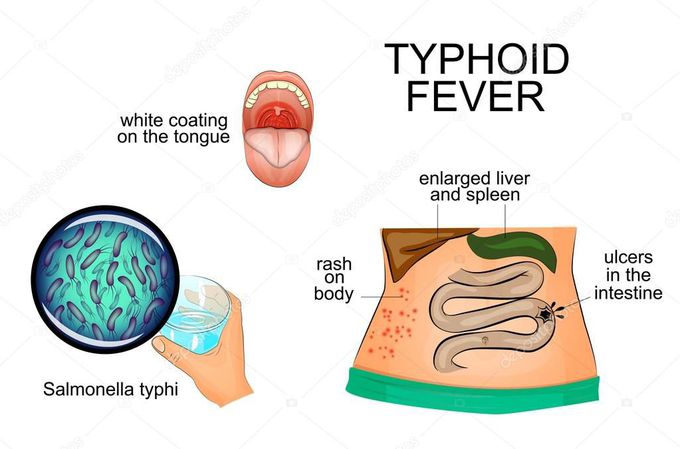 Typhoid fever