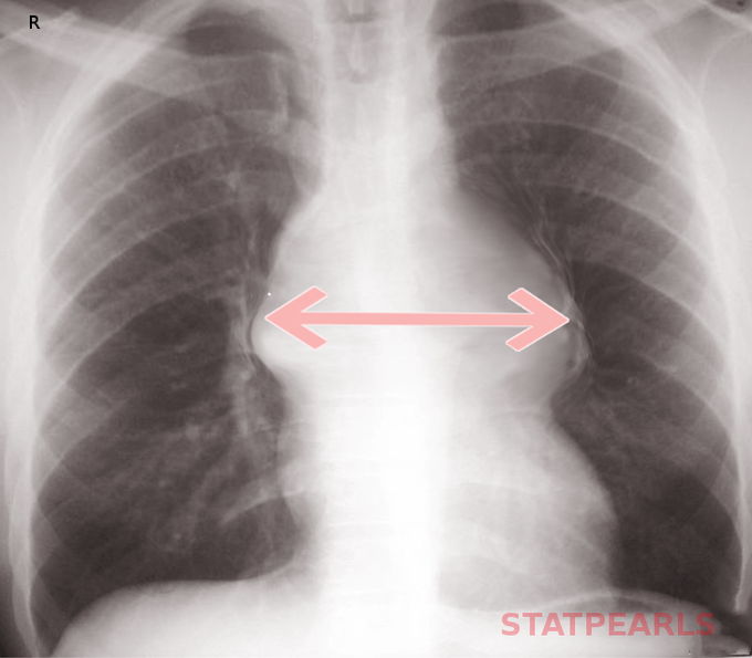 Widened Mediastinum in Aortic Dissection