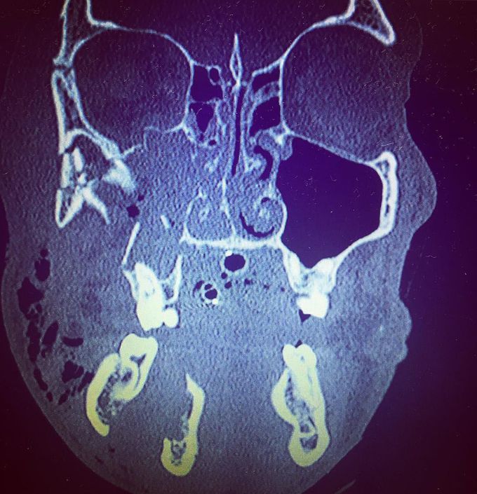 Coronal slice of CT scan