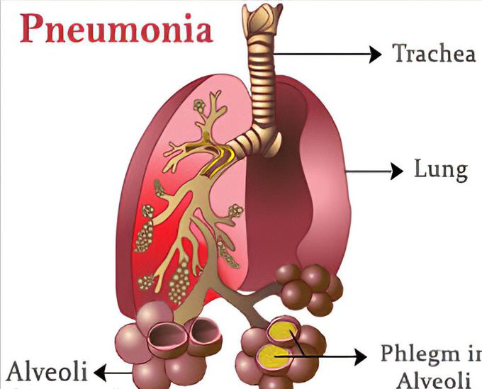 Pneumonia