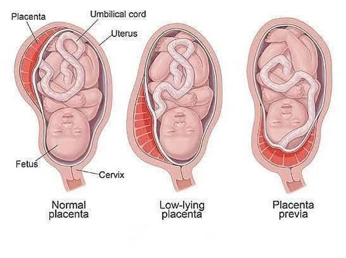 Placenta Previa