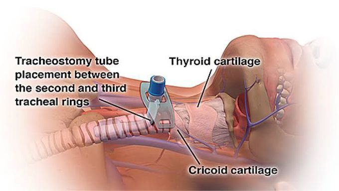 Tracheostomy