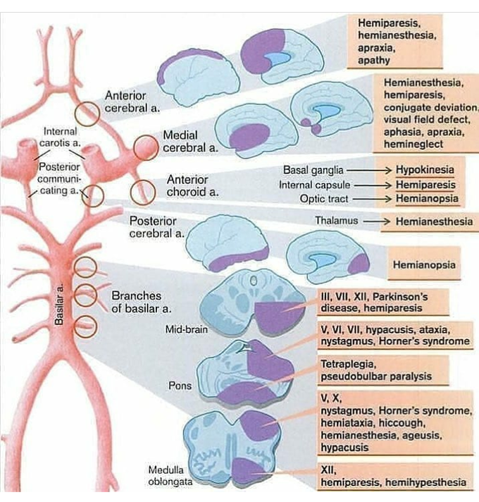 Different sites of stroke and clinical manifestations