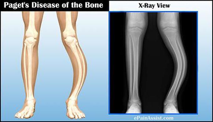 Paget’s Disease