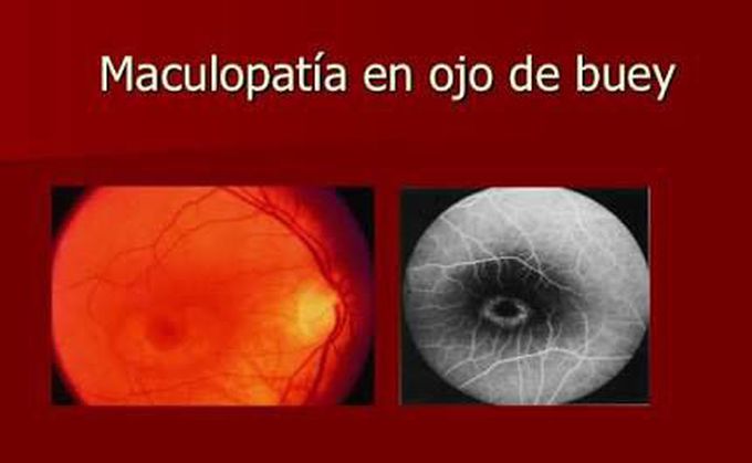 Maculopatia en ojo de buey