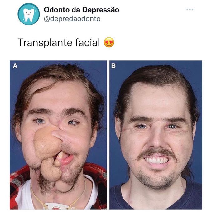 Before and after of a face transplant