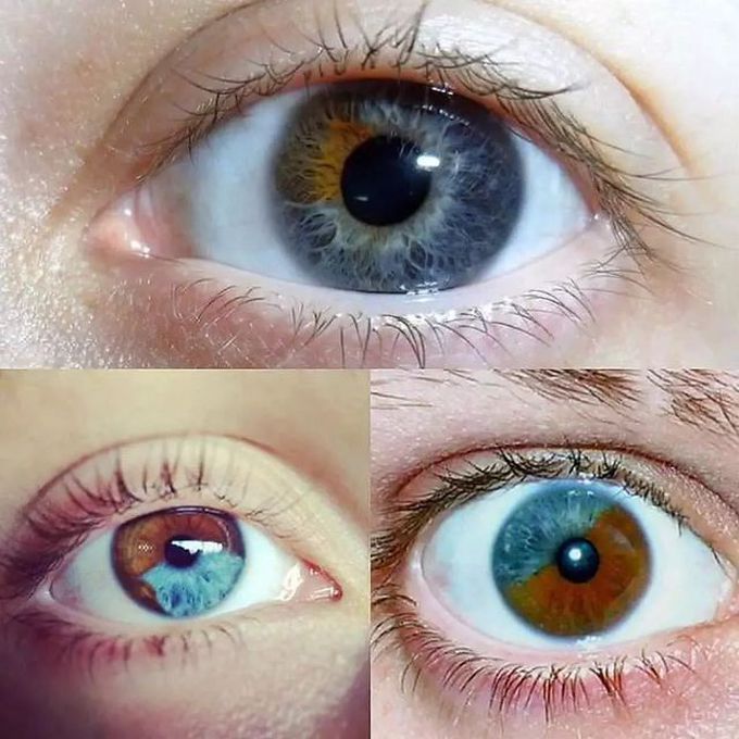 Heterochromia.