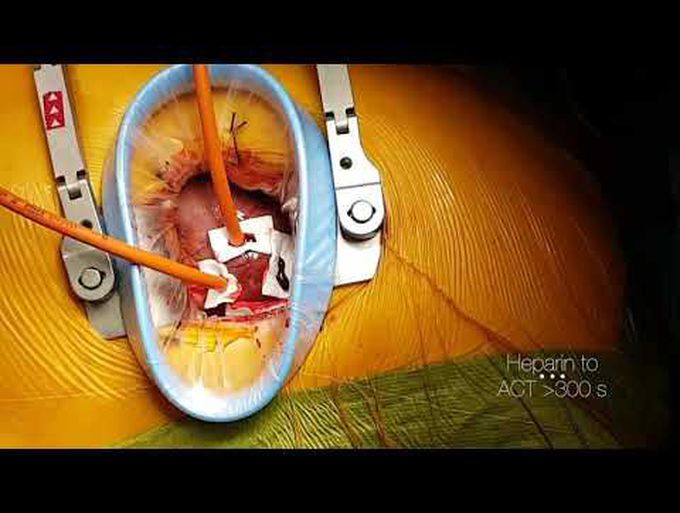 Transapical Off-Pump Mitral Valve Repair With NeoChord DS1000 Device