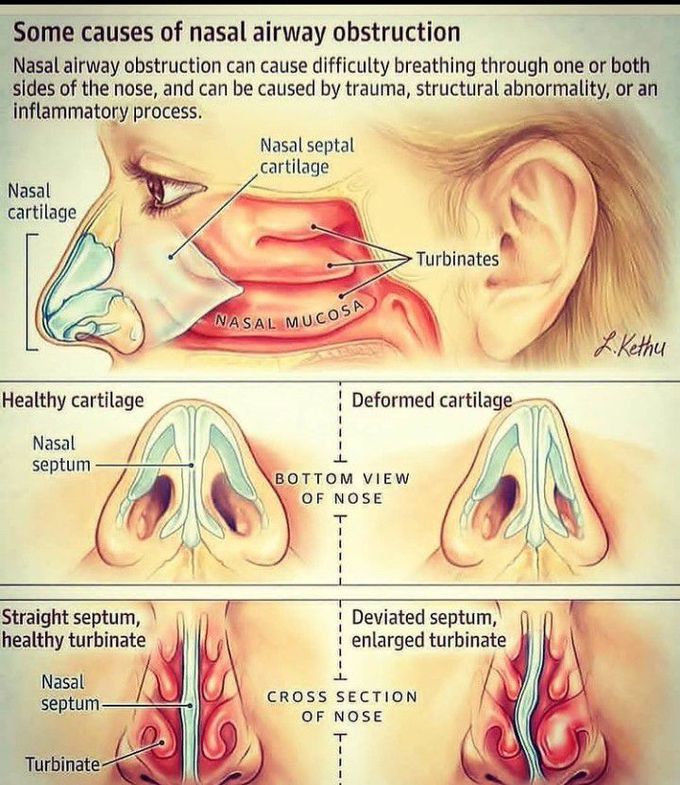 Causes of nasal obstruction
