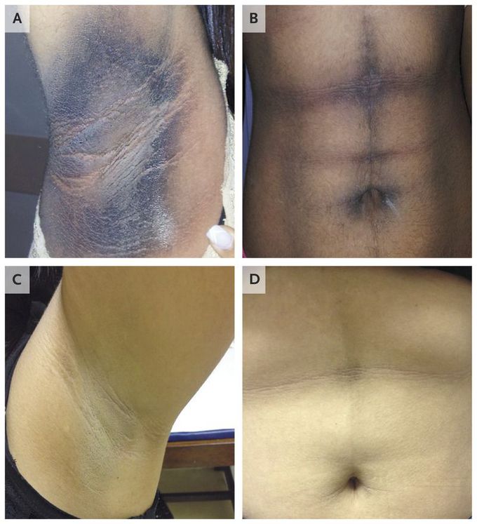 Acanthosis Nigricans and Insulin Resistance