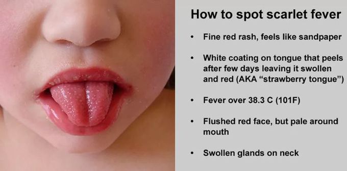 Cause of Scarlet fever