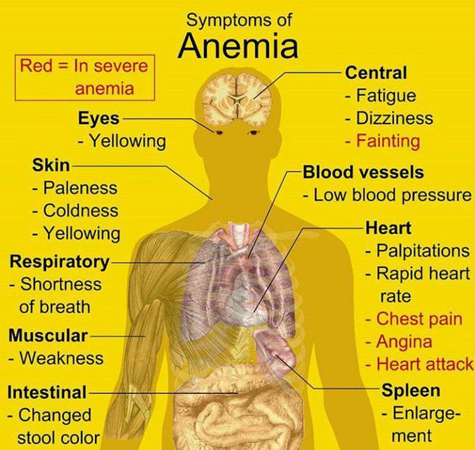Anemia
