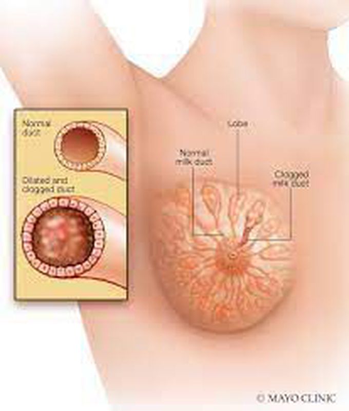 Management of duct ectasia