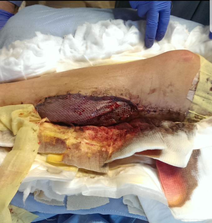 Lower Leg Fasciotomy