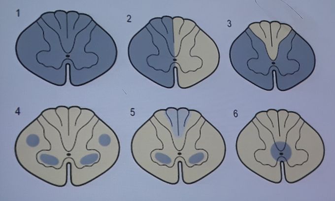 Spinal cord diseases