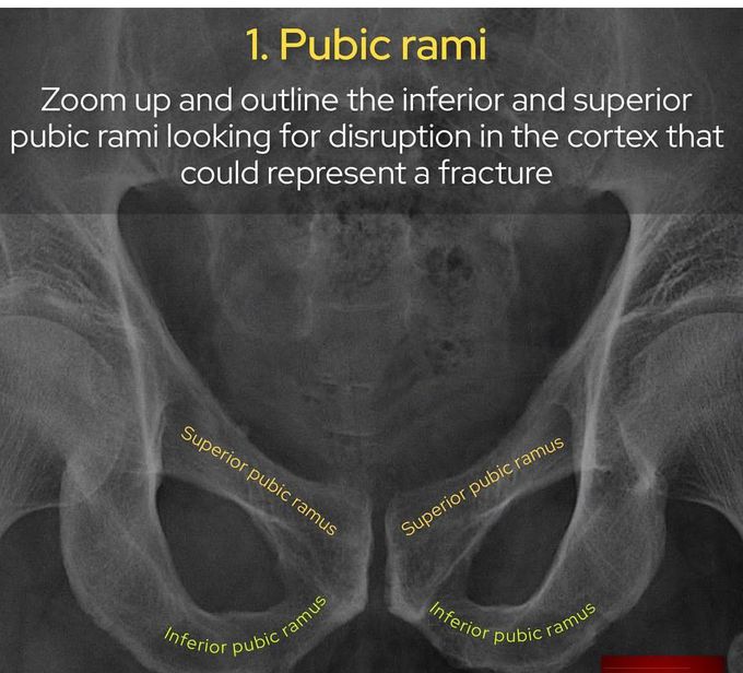 Pubic Rami