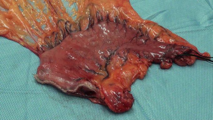 Gastrectomy