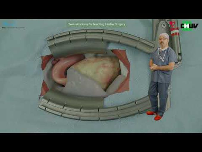 Demystifying Mitral Valve Regurgitation Repair: Surgical Techniques for Residents in Cardiac Surgery