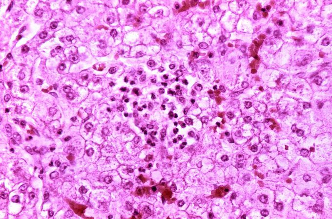 Appearance of a liver from a child who died of Reye syndrome as seen with a microscope. Hepatocytes are pale-staining due to intracellular fat droplets.