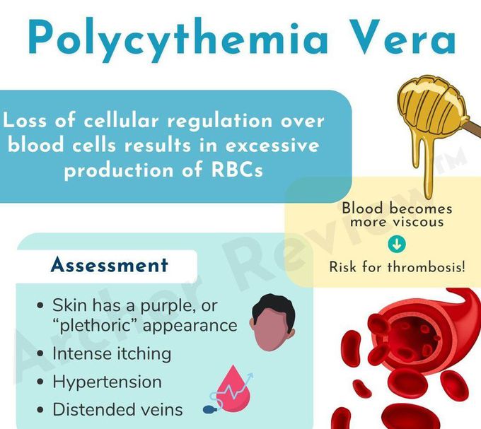 Polycythemia Vera