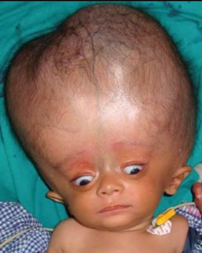 Hydrocephalus - MEDizzy