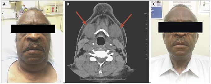 Iodide-Associated Sialadenitis