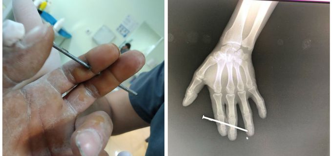 Work accident.