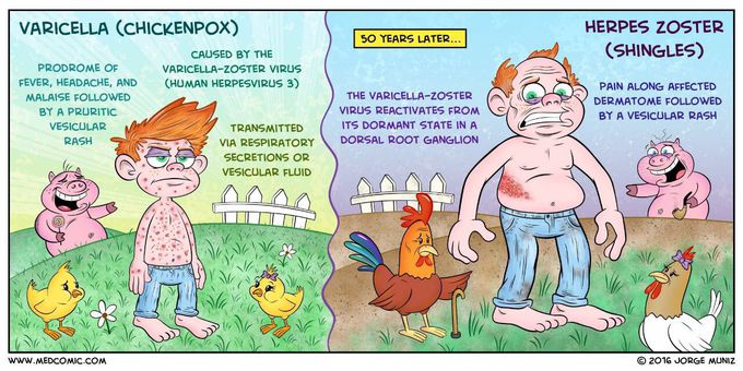 Chickenpox vs shingles