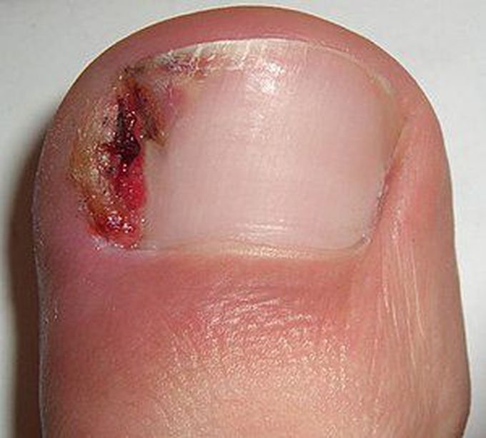 Cause of ingrown toenail