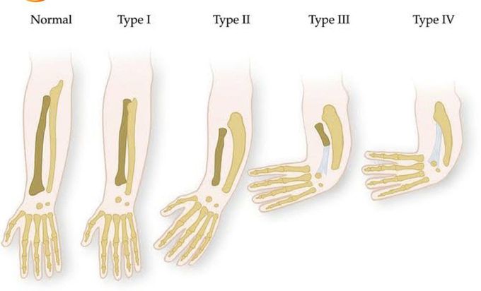 Radial Longitudinal Deficiency