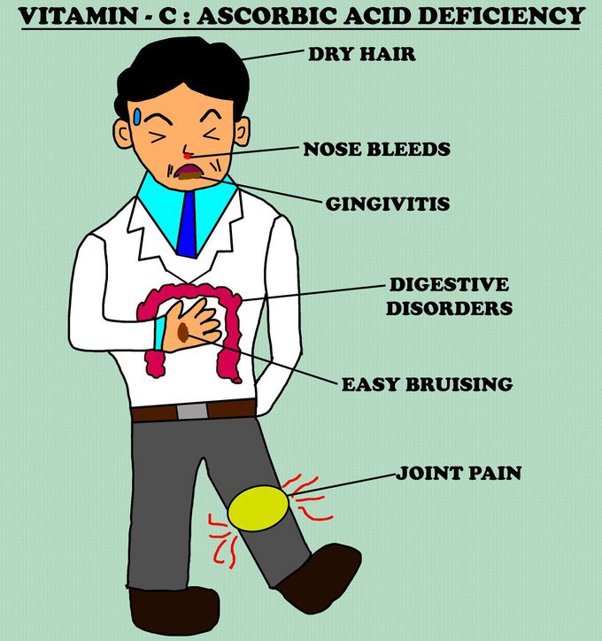 Vitamin C Deficiency Manifestations Medizzy