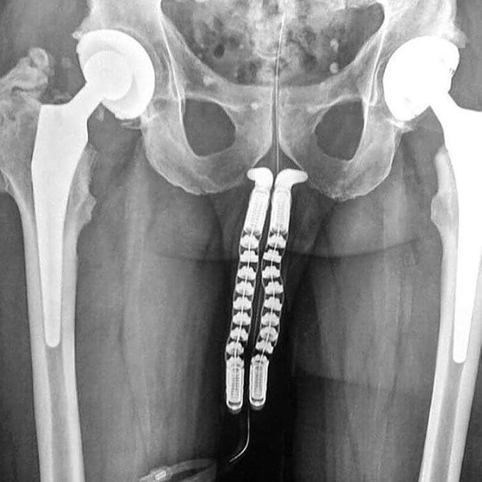 Here is a really interesting X-Ray of a penile transplant during a sex change. 