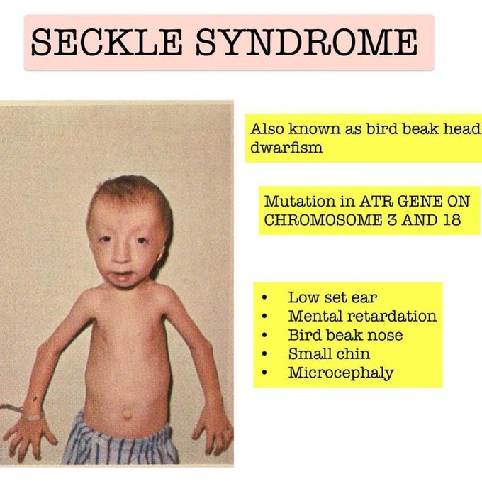 Seckle Syndrome